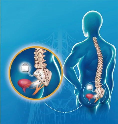 Traitement du syndrome de la douleur du plancher pelvien